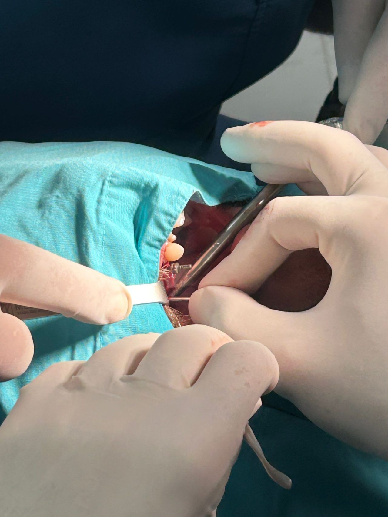 Ugradnja implantata Doboj