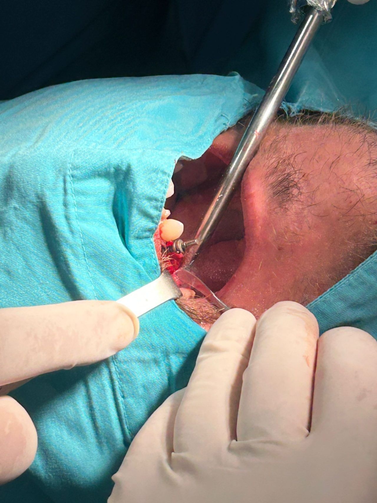 Ugradnja implantata Doboj