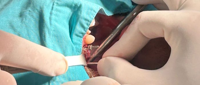 11 Ugradnja zubnih implantata – Smile Dent Petrović Doboj