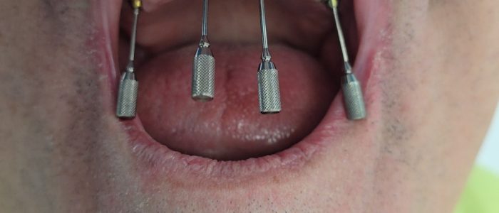 smiledent-petrovic-doboj-ugradnja-implantata Ugradnja zubnih implantata – Smile Dent Petrović Doboj