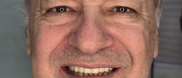 smiledent-petrovic-doboj-ugradnja-implantata Ugradnja zubnih implantata – Smile Dent Petrović Doboj