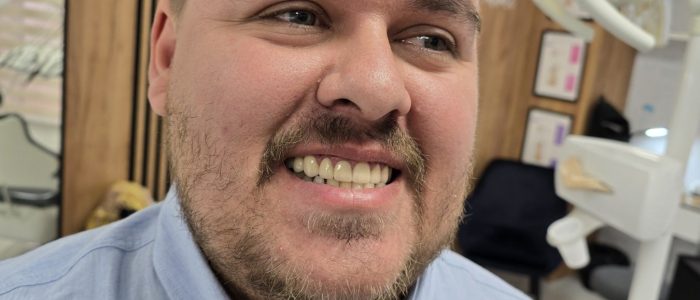 8 Ugradnja zubnih implantata – Smile Dent Petrović Doboj