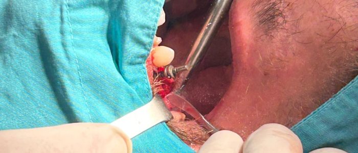 9 Ugradnja zubnih implantata – Smile Dent Petrović Doboj