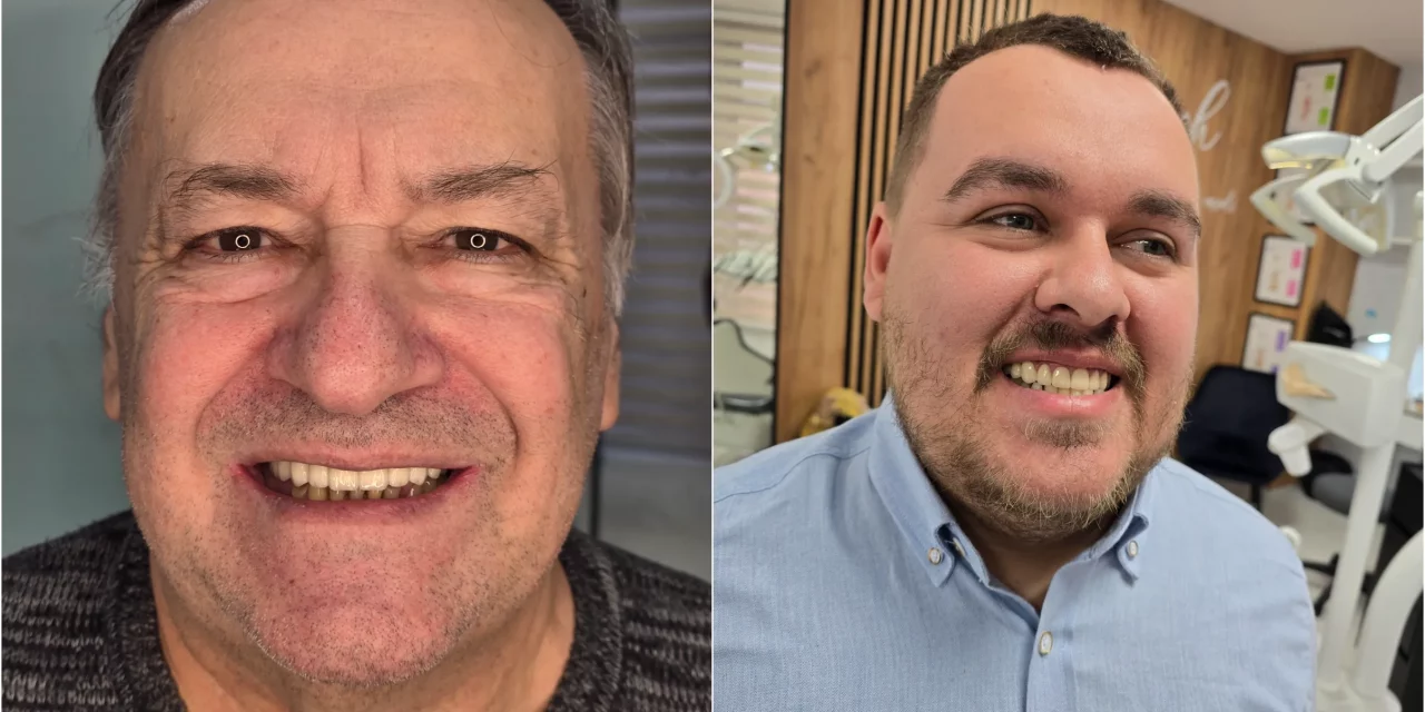 Ugradnja zubnih implantata – trajno rješenje vašeg osmijeha