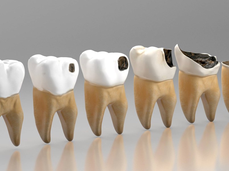 Karijes kao oboljenje tvrdih zubnih tkiva FOTO